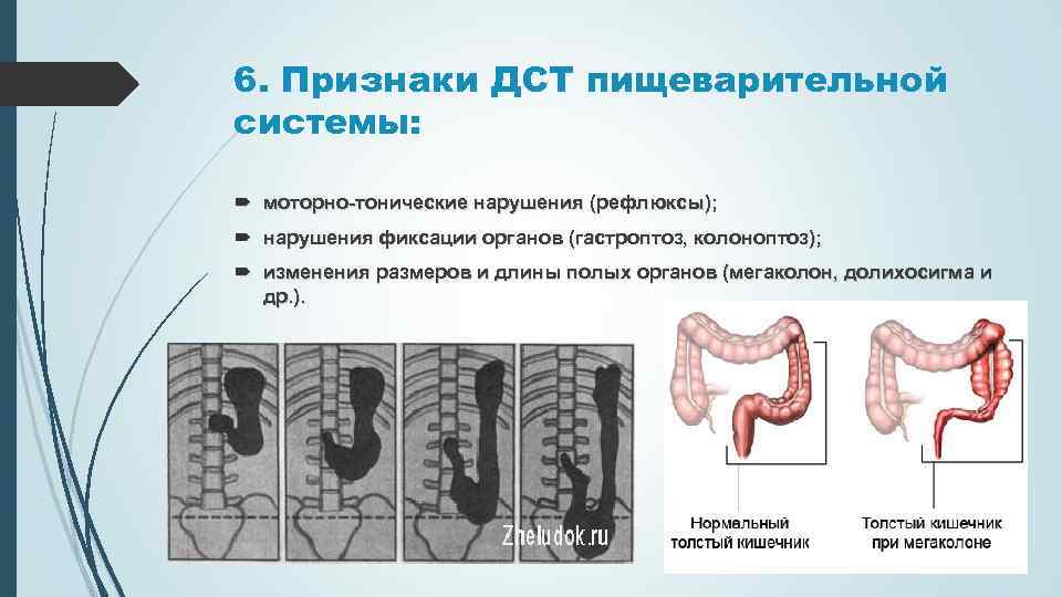 Трансверзоптоз кишечника