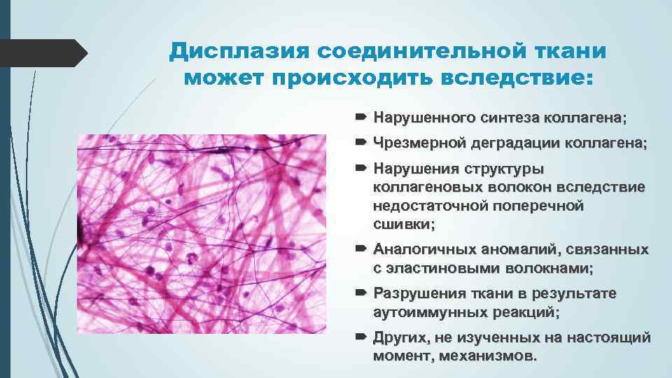 Нарушение коллагена. Нарушение развития соединительной ткани. ДСТ соединительной ткани. Эластиновые волокна соединительной ткани. Соединительная тканная дисплазия.