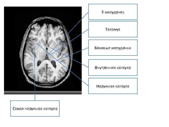 3 желудочек. Кт анатомия бокового желудочка головного мозга. Боковые желудочки головного мозга кт. Третий желудочек головного мозга кт. Желудочки головного мозга анатомия мрт.