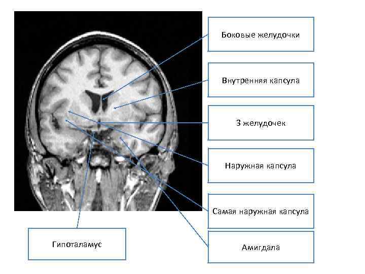 Асимметрия боковых желудочков головного мозга