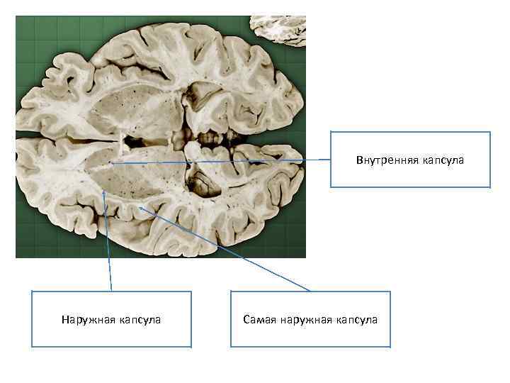 Внутренняя капсула Наружная капсула Самая наружная капсула 