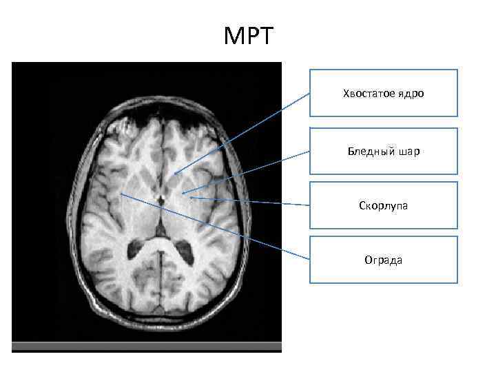 МРТ Хвостатое ядро Бледный шар Скорлупа Ограда 