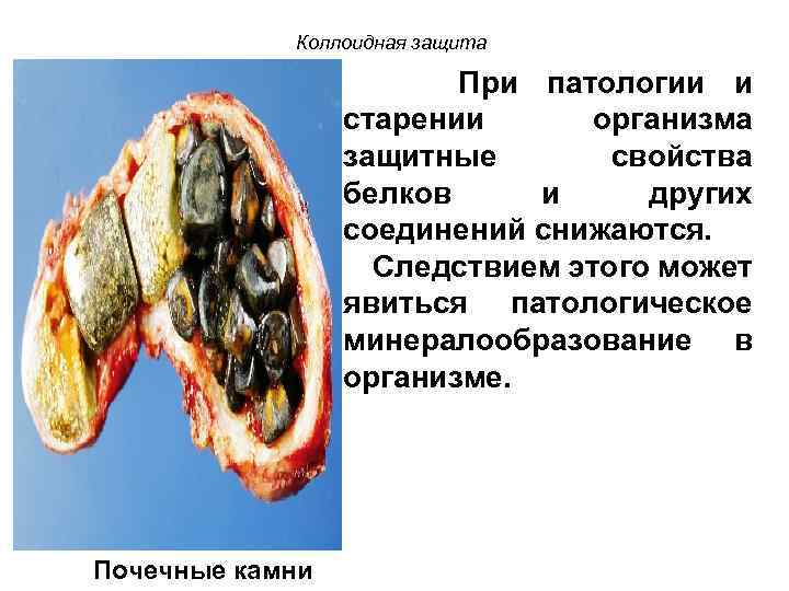Коллоидная защита При патологии и старении организма защитные свойства белков и других соединений снижаются.