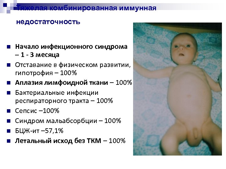 Тяжелая комбинированная иммунная недостаточность Начало инфекционного синдрома – 1 - 3 месяца Отставание в