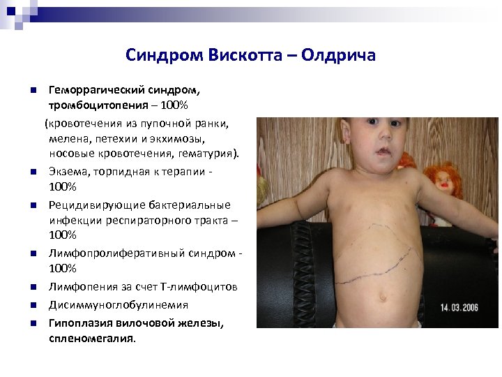 Синдром Вискотта – Олдрича Геморрагический синдром, тромбоцитопения – 100% (кровотечения из пупочной ранки, мелена,