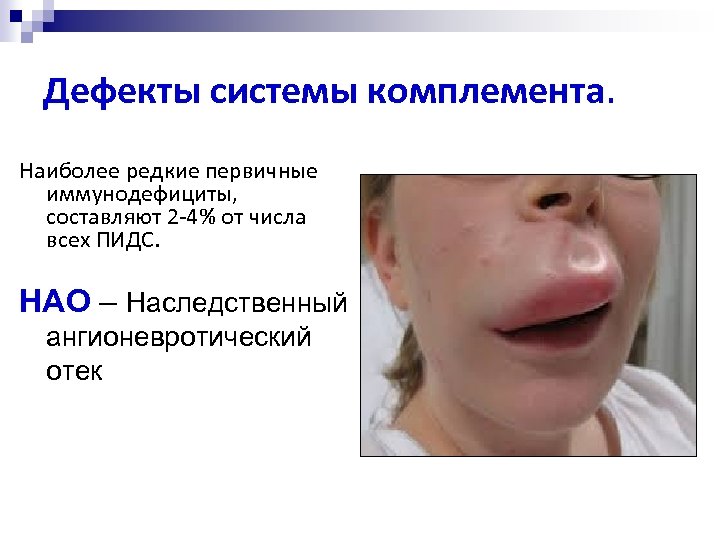 Дефекты системы комплемента. Наиболее редкие первичные иммунодефициты, составляют 2 -4% от числа всех ПИДС.