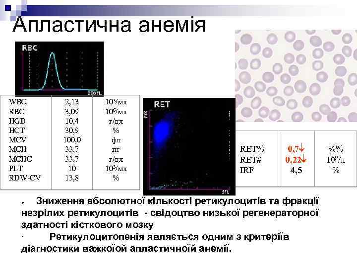 Апластична анемія WBC RBC HGB HCT MCV MCHC PLT RDW-CV 2, 13 3, 09