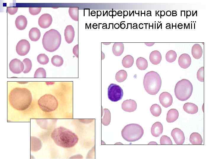 Периферична кров при мегалобластній анемії 