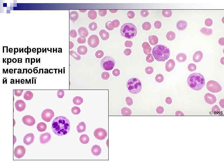 Периферична кров при мегалобластні й анемії 