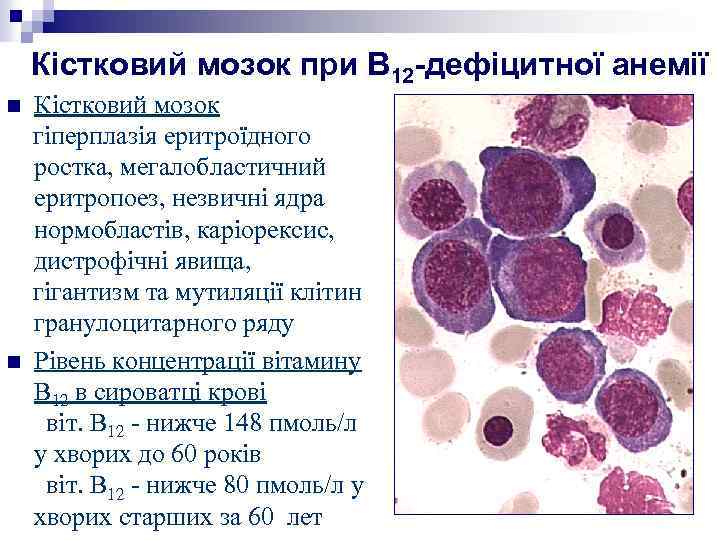 Кістковий мозок при В 12 -дефіцитної анемії Кістковий мозок гіперплазія еритроїдного ростка, мегалобластичний еритропоез,