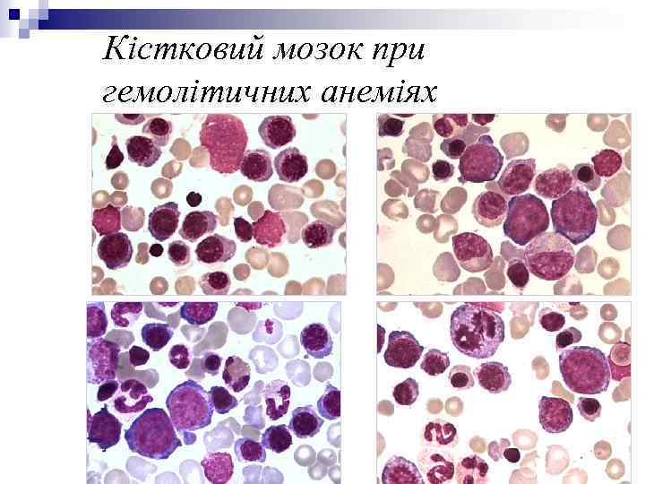 Кістковий мозок при гемолітичних анеміях 