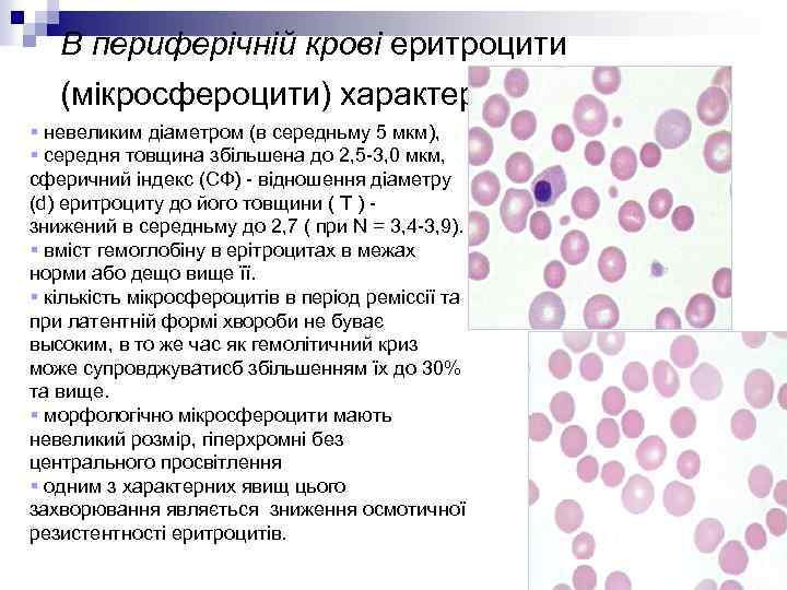 В периферічній крові еритроцити (мікросфероцити) характеризуються : § невеликим діаметром (в середньму 5 мкм),