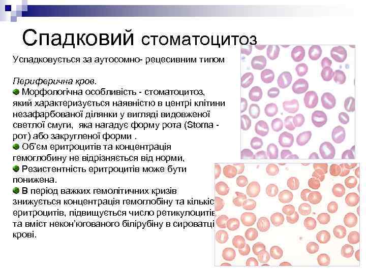 Спадковий стоматоцитоз Успадковується за аутосомно- рецесивним типом Периферична кров. Морфологічна особливість - стоматоцитоз, який