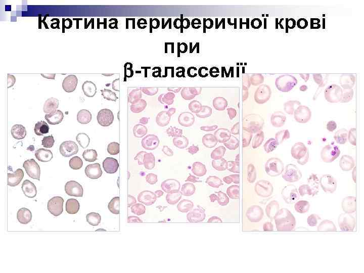 Картина периферичної крові при -талассемії 