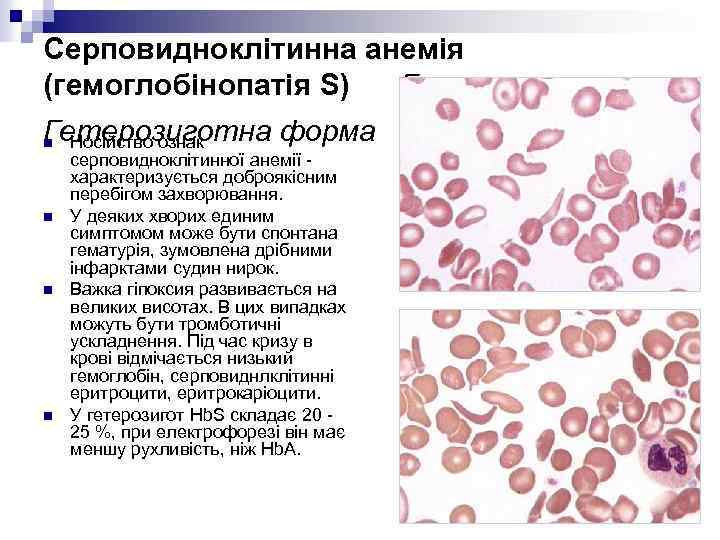 Серповидноклітинна анемія (гемоглобінопатія S) Гетерозиготна форма Носійство ознак n n серповидноклітинної анемії - характеризується