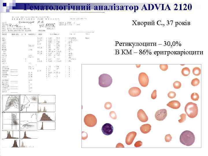 Гематологічний аналізатор ADVIA 2120 Хворий С. , 37 років Ретикулоцити – 30, 0% В