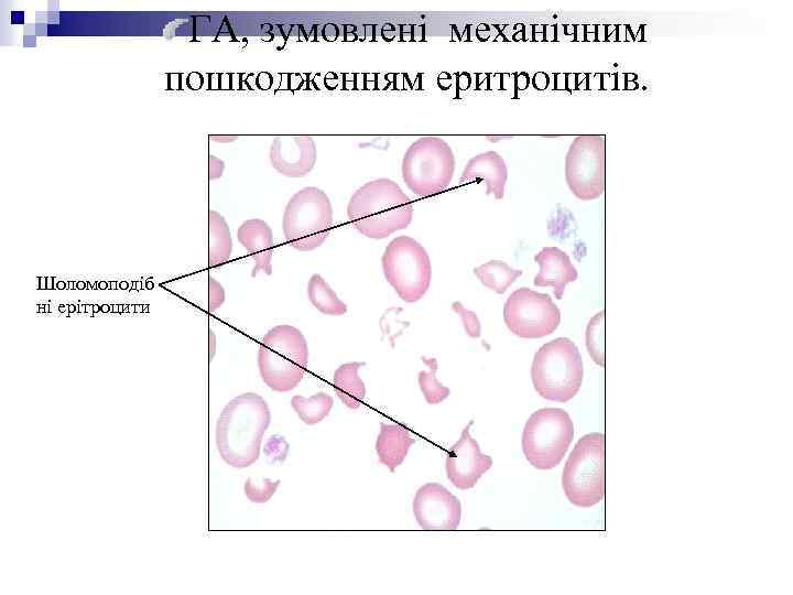 ГА, зумовлені механічним пошкодженням еритроцитів. Шоломоподіб ні ерітроцити 