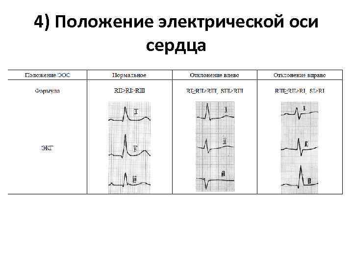 4) Положение электрической оси сердца 