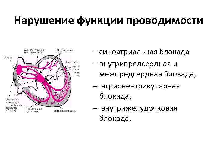 Нарушение функции проводимости – синоатриальная блокада – внутрипредсердная и межпредсердная блокада, – атриовентрикулярная блокада,