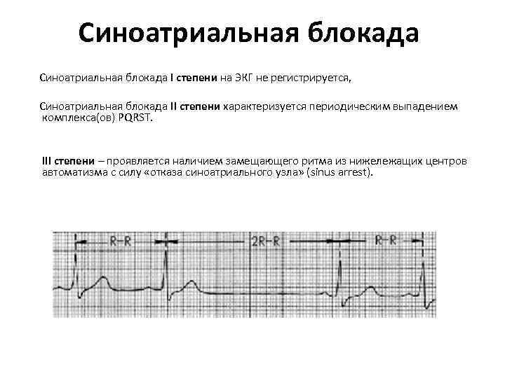 Признаки синоатриальной блокады