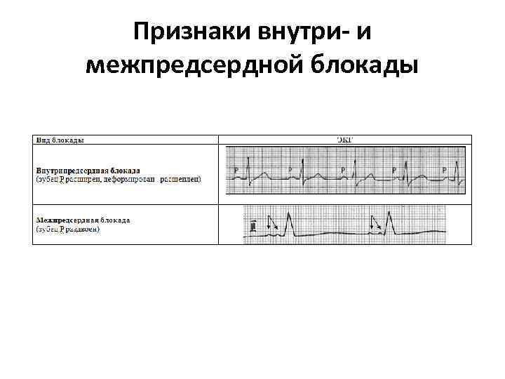 Схема расположения электродов экг