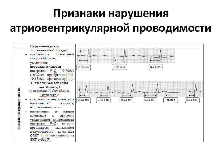 Признаки нарушения атриовентрикулярной проводимости 