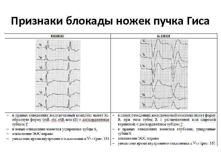 Признаки блокады ножек пучка Гиса 