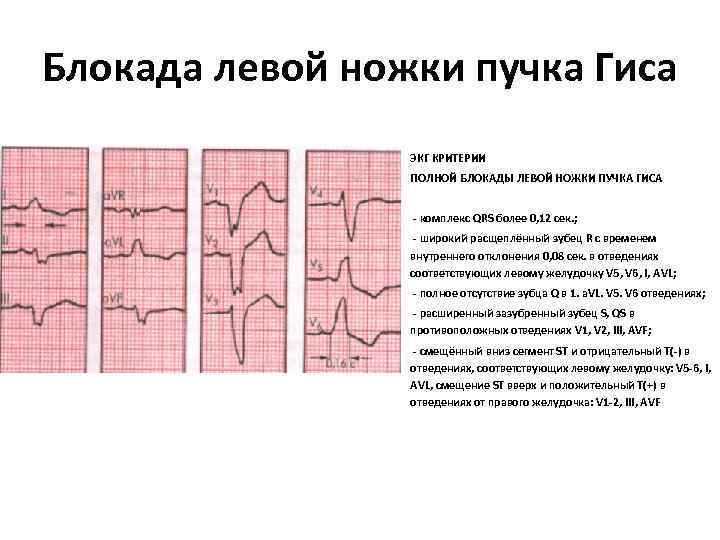 Блокада левой ножки пучка Гиса ЭКГ КРИТЕРИИ ПОЛНОЙ БЛОКАДЫ ЛЕВОЙ НОЖКИ ПУЧКА ГИСА -