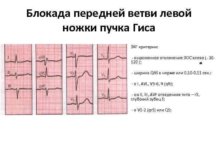 Блокада передней ветви левой ножки пучка Гиса ЭКГ критерии: - выраженное отклонение ЭОС влево