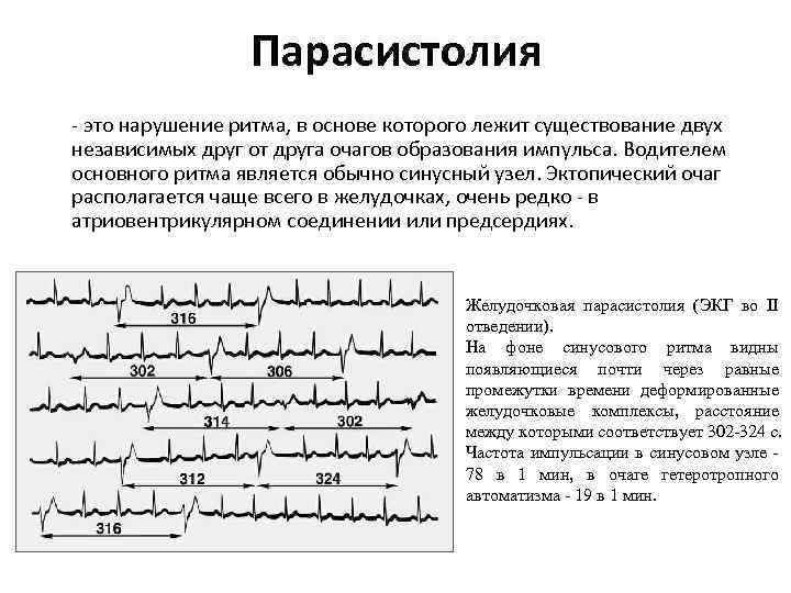 Парасистолия - это нарушение ритма, в основе которого лежит существование двух независимых друг от