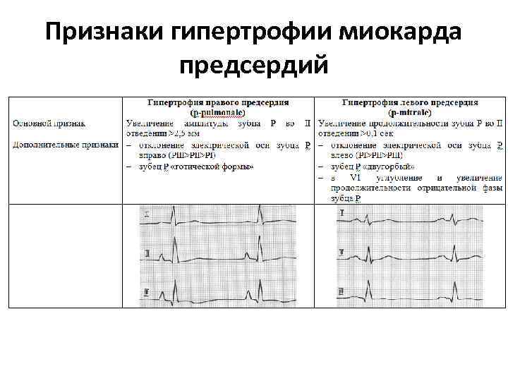 Признаки гипертрофии миокарда предсердий 