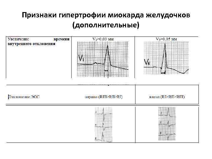 Признаки гипертрофии миокарда желудочков (дополнительные) 