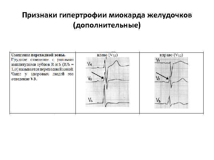 Признаки гипертрофии миокарда желудочков (дополнительные) 