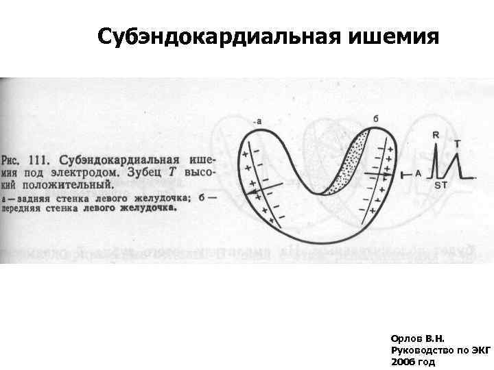 Субэндокардиальная ишемия Орлов В. Н. Руководство по ЭКГ 2006 год 