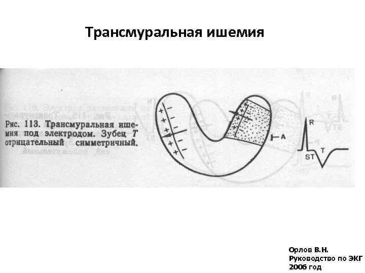 Трансмуральная ишемия Орлов В. Н. Руководство по ЭКГ 2006 год 