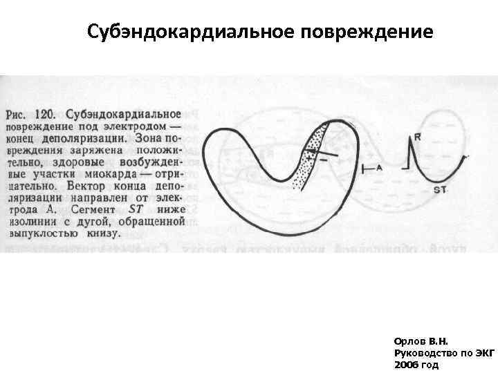 Субэндокардиальное повреждение Орлов В. Н. Руководство по ЭКГ 2006 год 