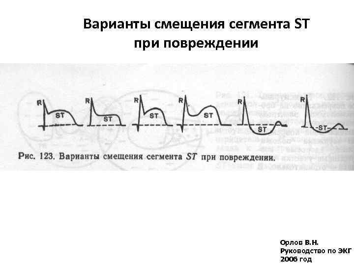 Варианты смещения сегмента ST при повреждении Орлов В. Н. Руководство по ЭКГ 2006 год