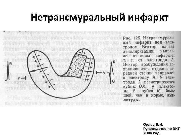 Нетрансмуральный инфаркт Орлов В. Н. Руководство по ЭКГ 2006 год 