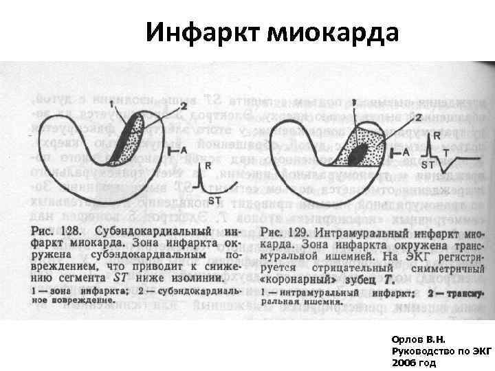 Инфаркт миокарда Орлов В. Н. Руководство по ЭКГ 2006 год 