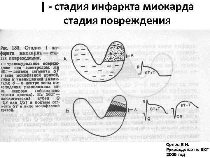 | - стадия инфаркта миокарда стадия повреждения Орлов В. Н. Руководство по ЭКГ 2006