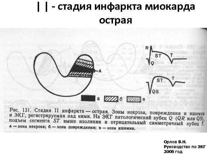 Кардиоджет инструкция по применению схема наложения электродов