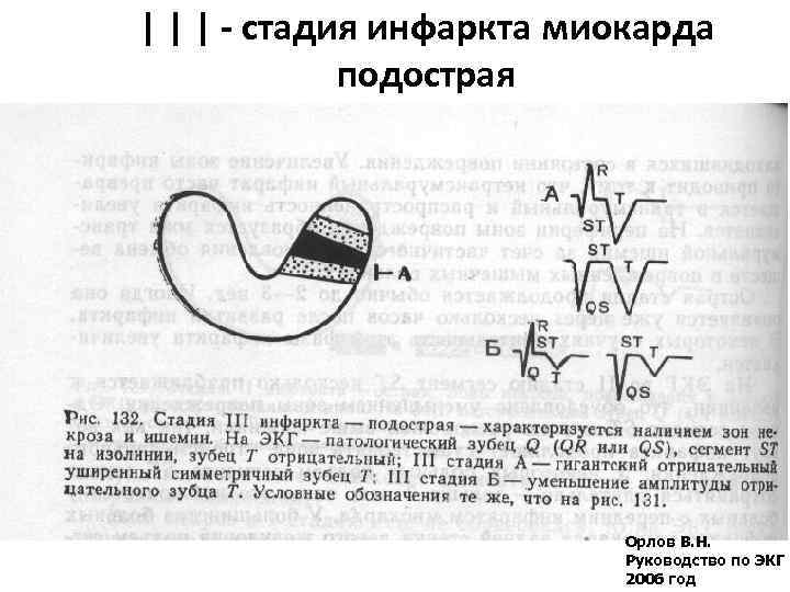 | | | - стадия инфаркта миокарда подострая Орлов В. Н. Руководство по ЭКГ