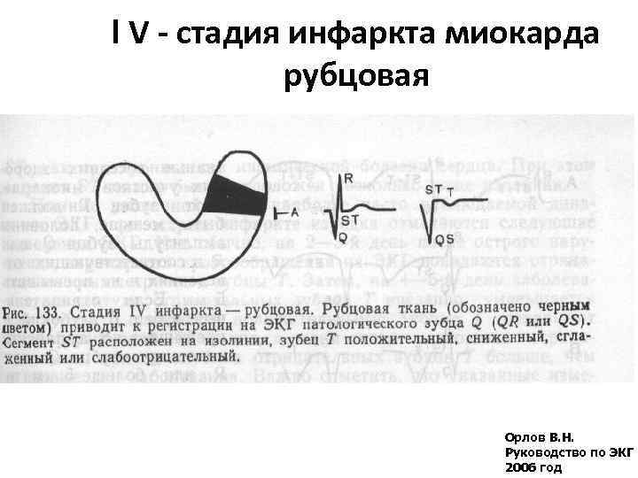 l V - стадия инфаркта миокарда рубцовая Орлов В. Н. Руководство по ЭКГ 2006