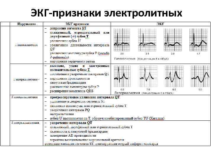 ЭКГ-признаки электролитных нарушений 