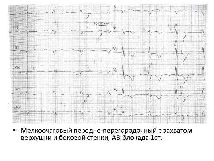 Признаки трансмурального инфаркта. Инфаркт миокарда передней перегородки на ЭКГ. Мелкоочаговый инфаркт миокарда на ЭКГ. Мелкоочаговый инфаркт на ЭКГ. Передне-перегородочный с захватом верхушки инфаркт миокарда на ЭКГ.