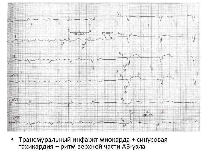  • Трансмуральный инфаркт миокарда + синусовая тахикардия + ритм верхней части АВ-узла 