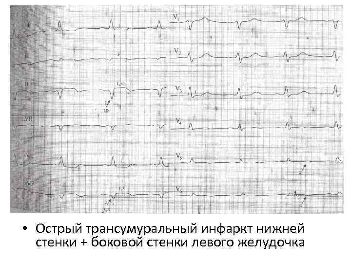 Снять экг наложение электродов фото как правильно