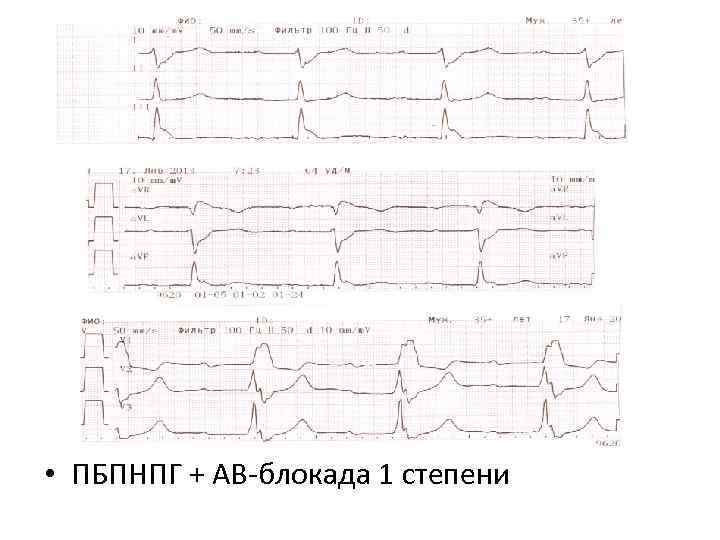  • ПБПНПГ + АВ-блокада 1 степени 