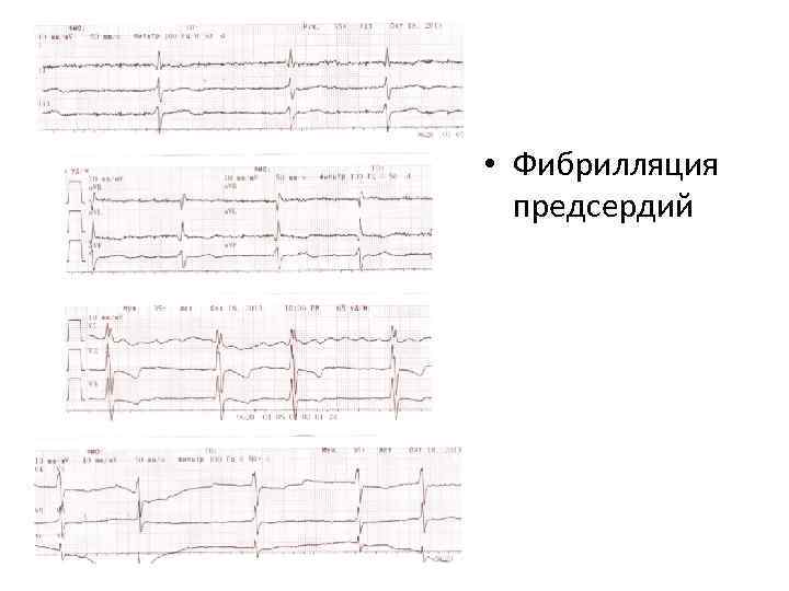  • Фибрилляция предсердий 