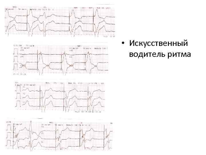  • Искусственный водитель ритма 